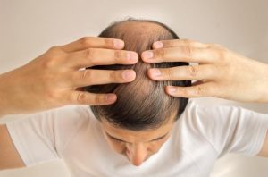 Treatment for Baldness